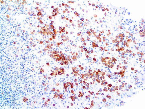 IHC of Cytokeratin 5 on an FFPE Mesothelioma Tissue
